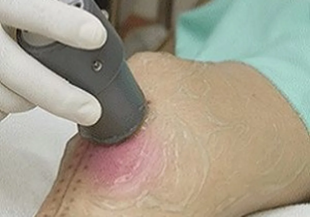 skin wound treatment using ultrasound