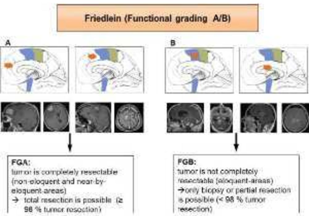 The Friedlein Grading A/B classification system 