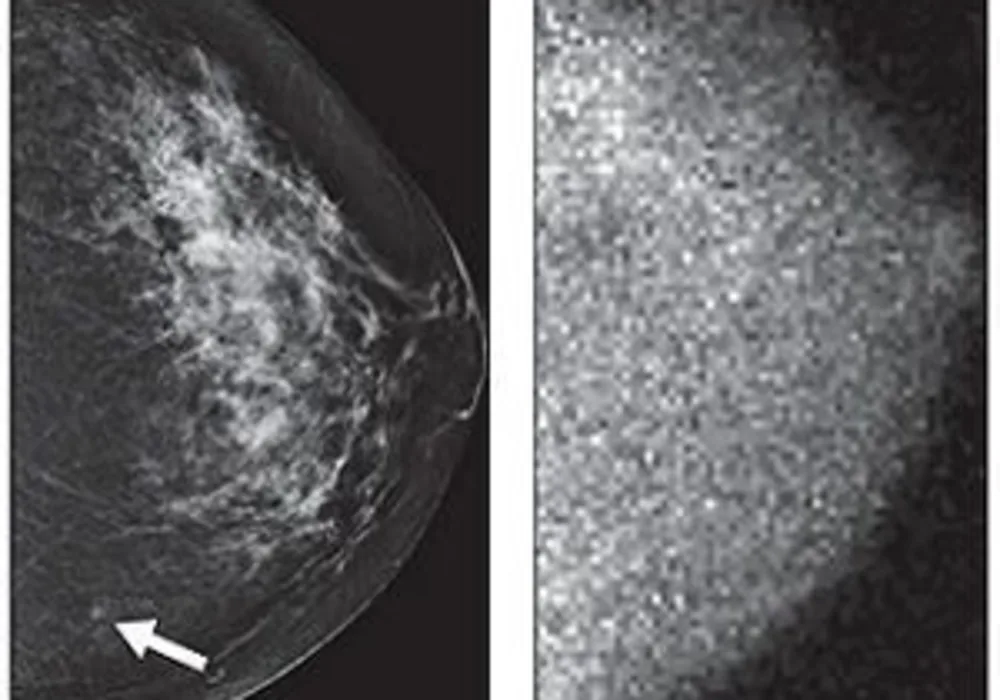 small MBI-occult invasive ductal carcinoma