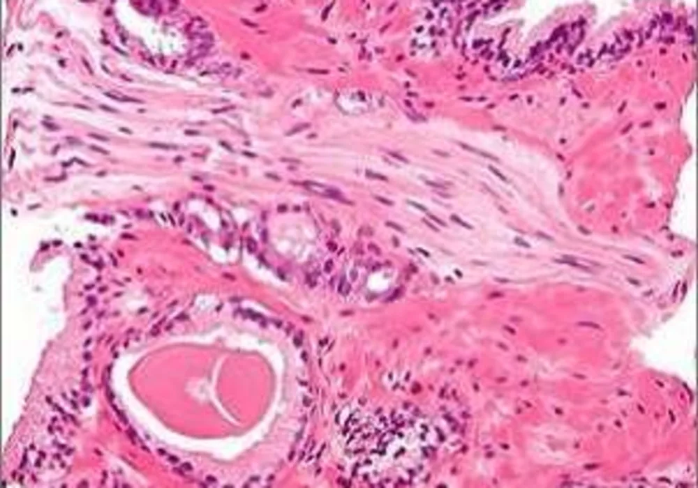 micrograph showing a prostate cancer