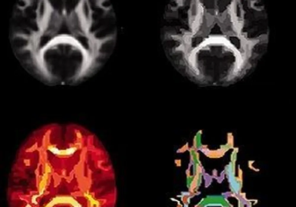 neonatal MRI and childhood cognitive outcome