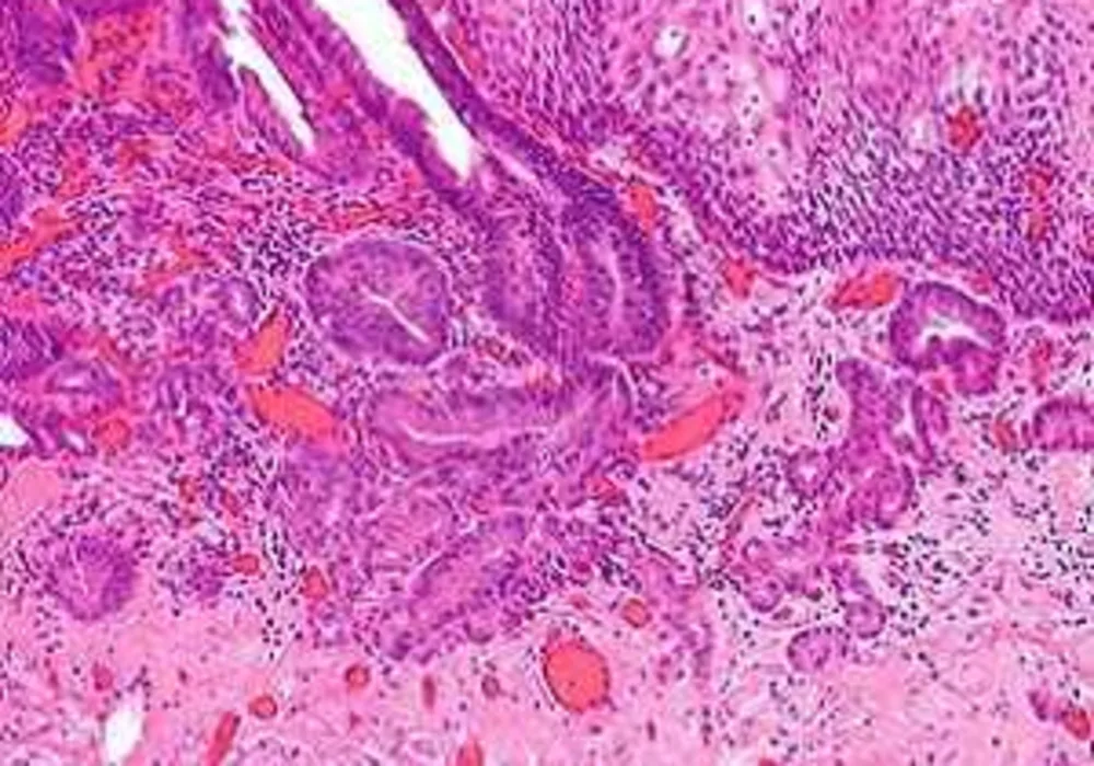 (micrograph) intramucosal oesophageal adenocarcinoma 