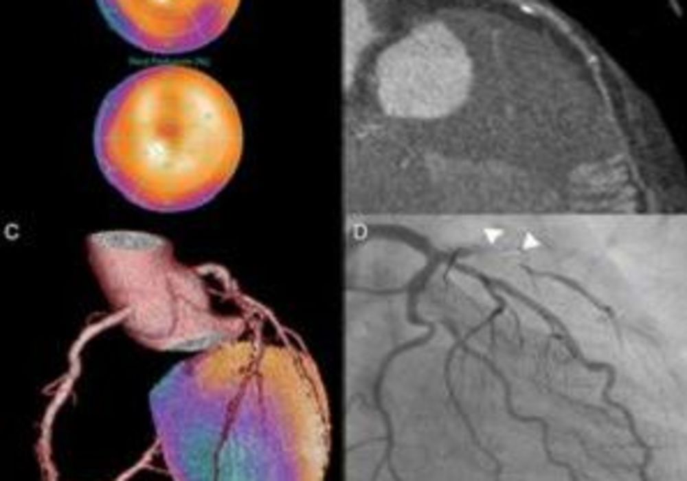 SPECT/CT images from a patient with typical angina