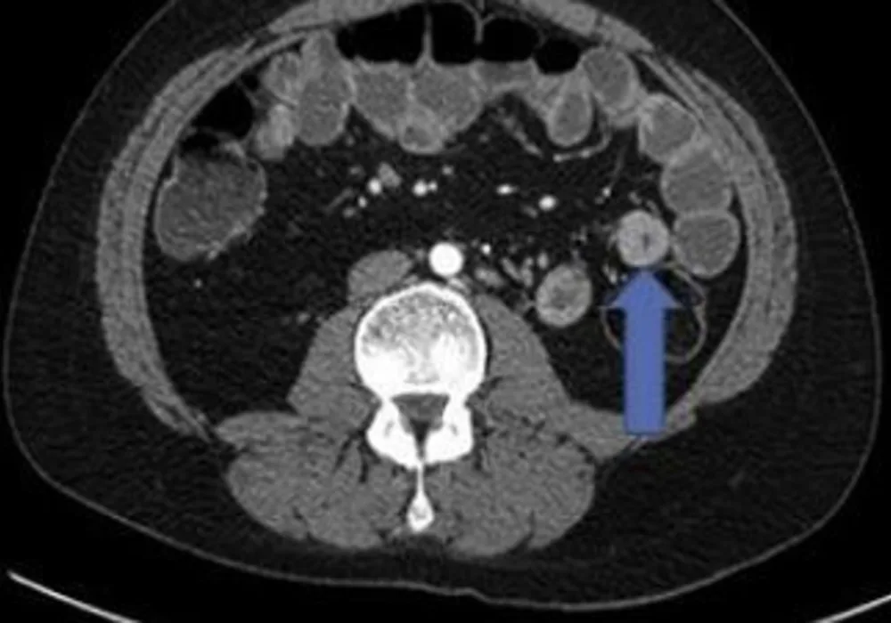 thickening of the small bowel as seen in Crohn disease