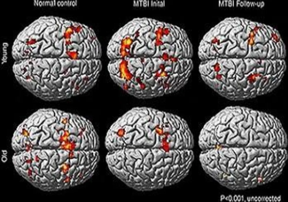 fMRI images of patients with MTBI