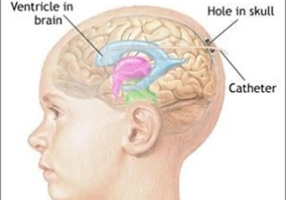 intracranial pressure monitoring (ICP)