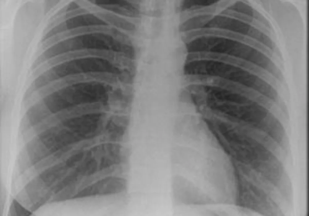 chest x-ray close-up