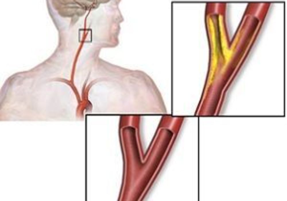 carotid artery disease