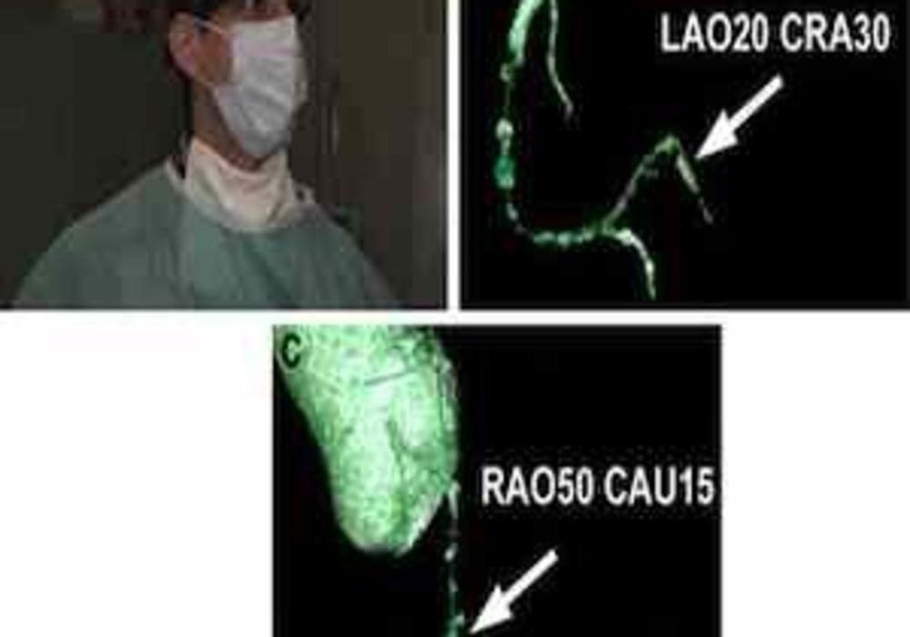 CTA images displayed in Google Glass. (A) Cardiologist viewing the CTA images in the upper right visual field on Google Glass (Google Inc, Mountain View, CA) (arrow) during a CTO recanalization attempt. (B, C) Three-dimensional reconstructions projected d