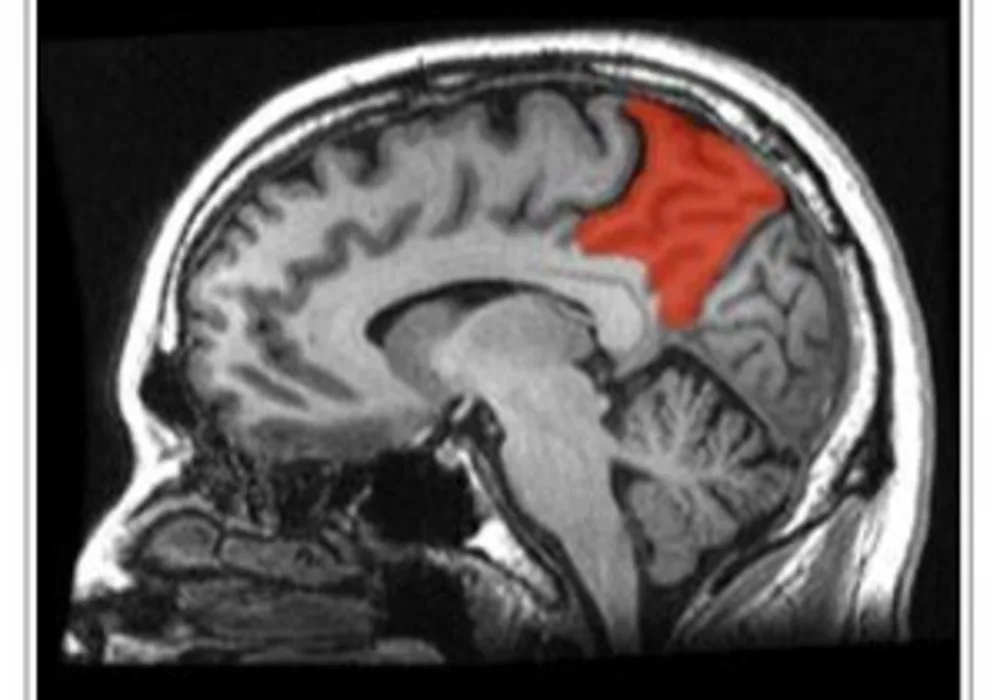 sagittal MRI slice with the precuneus shown in red