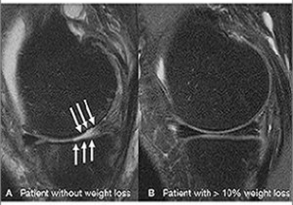 knee MRI scans