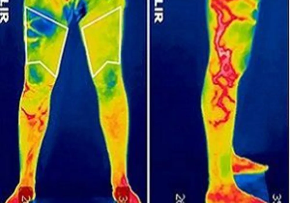 infrared thermography helps detect orthopaedic injury