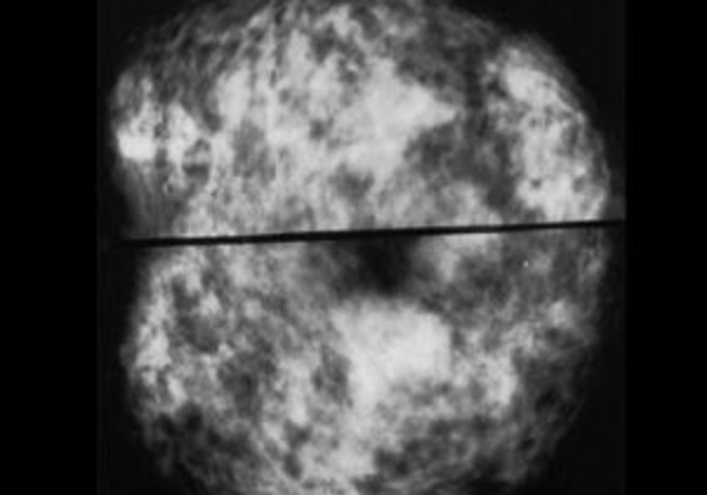 two mammograms of normal dense breasts