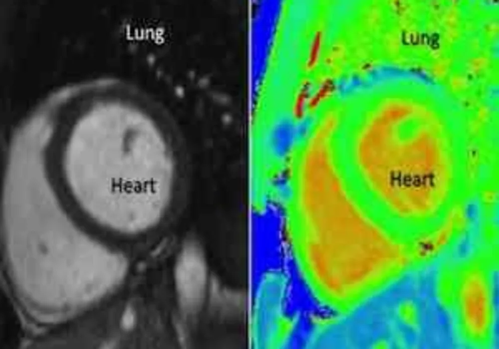 Black and white MRI pictures (left) to diagnose heart disease used today which can be very subjective. These could be replaced with colour coded pictures in the future. 