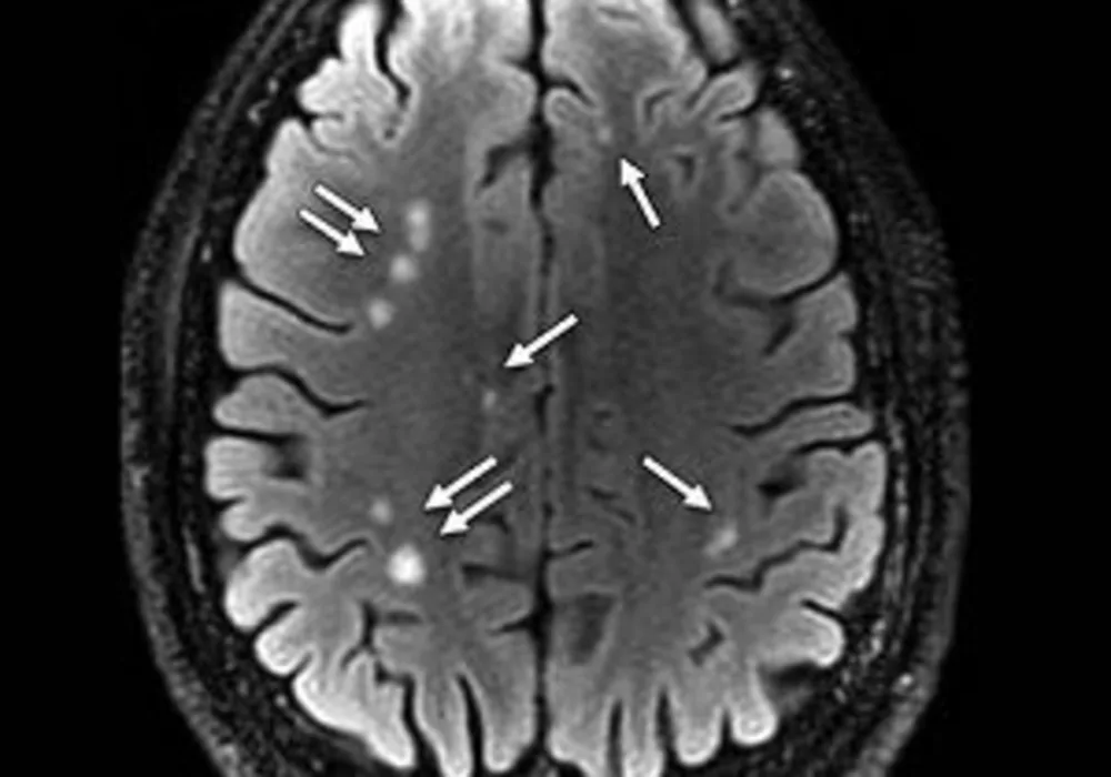 brain scan showing multiple white matter T2-weighted hyperintense areas (arrows)