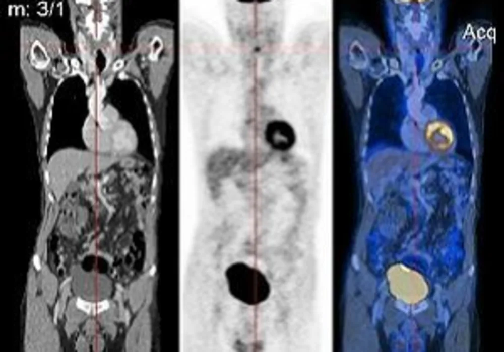 CT image (left), PET image (centre) and overlay of both (right)