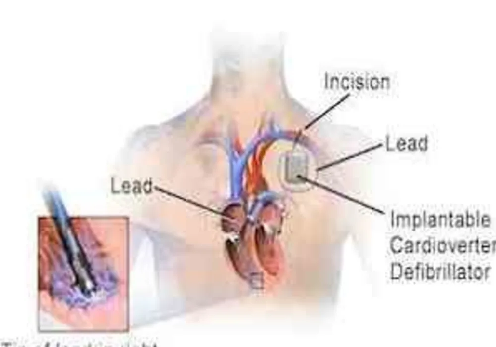 Implantable Cardioverter Defibrillator 