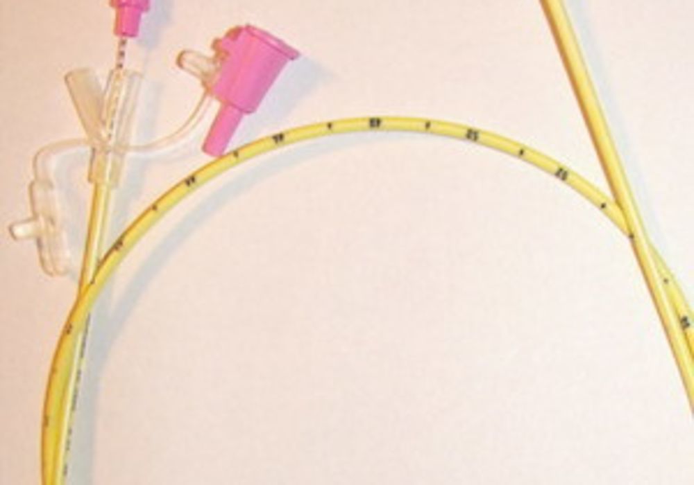 Nasogastric feeding tube