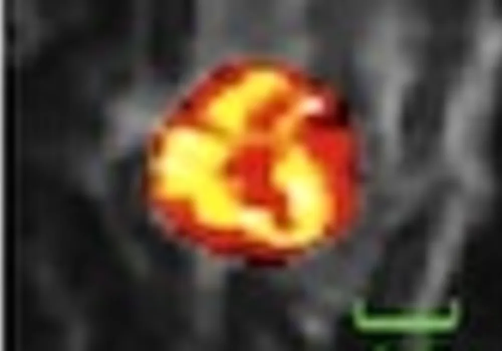 Differences in dynamic textural patterns are apparent between a patient with a low recurrence score and a patient with a high recurrence score