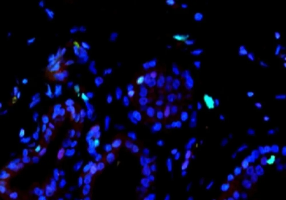 In healthy breast tissue, the percentage of cells expressing molecular marker Ki67 (green) and p27 (red) is low. Photo: Sung Jin Huh