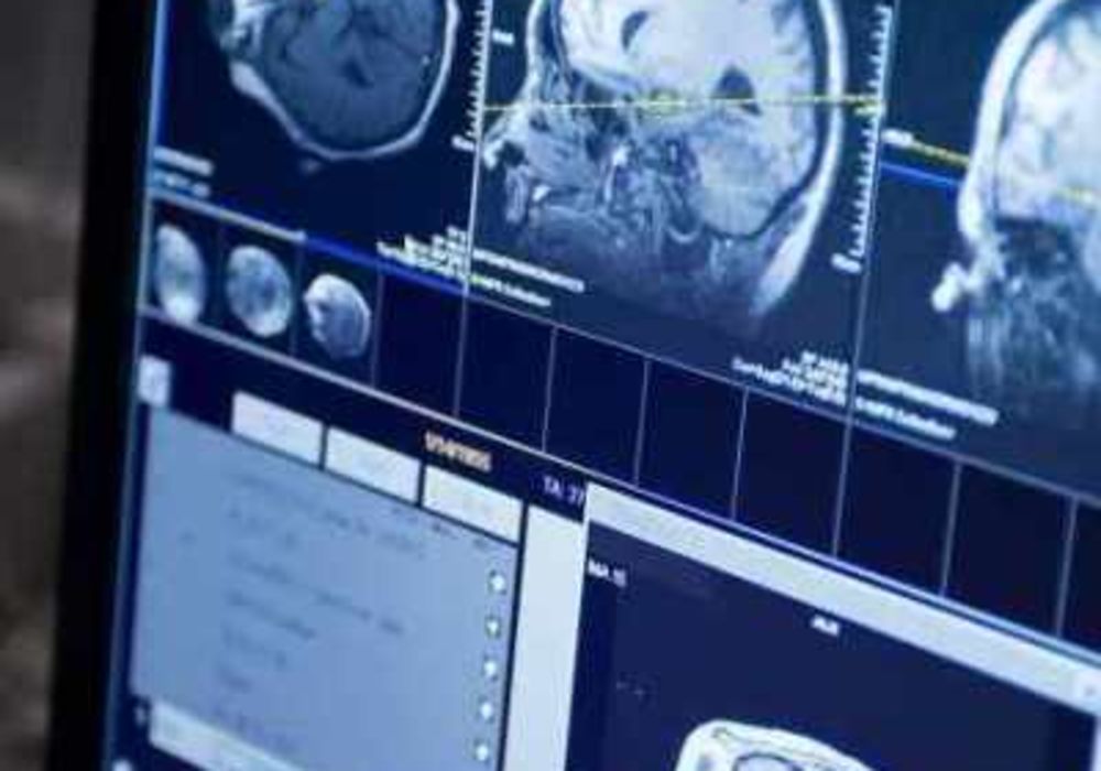 Radiation-Chemo Combo Prolongs Survival in Low-Grade Brain Tumour