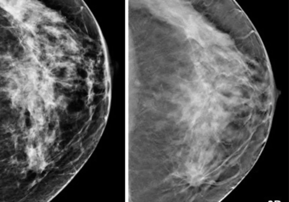 3D Of Dense Breasts To Help Slash Recall Rate, Cost For Cancer Screening