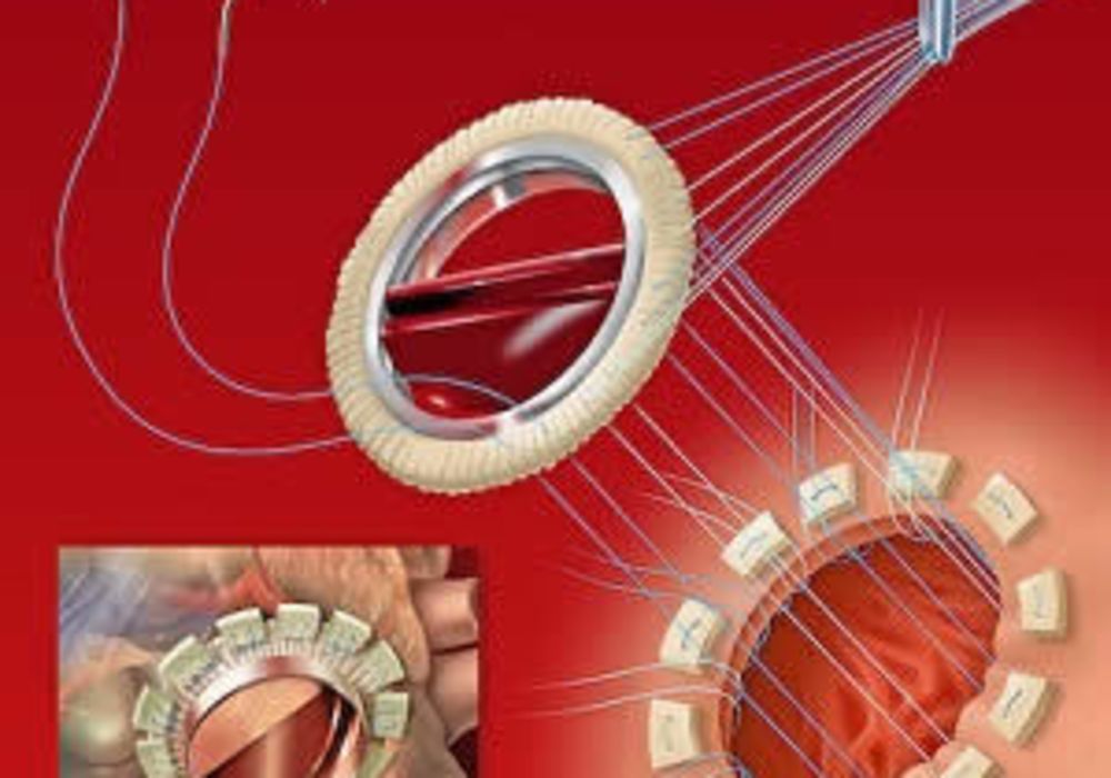 Imaging Assessment of Prosthetic Heart Valves