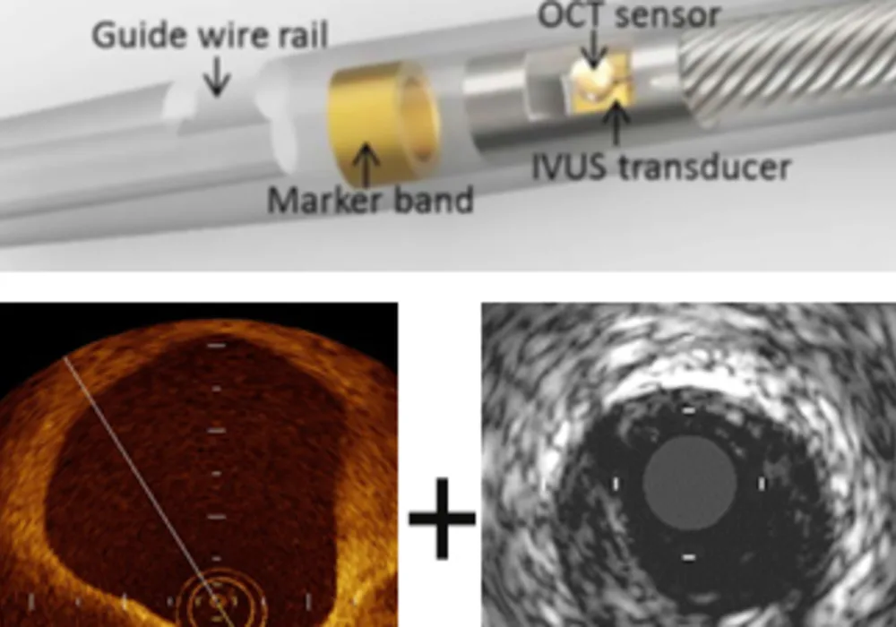 The dual catheter OCT-IVUS imaging device can be inserted into an artery to simultaneously capture an infrared image of the arterial wall (OCT, at left) and an ultrasound image (IVUS, right) that doctors use to determine the potential that a plaque is sus