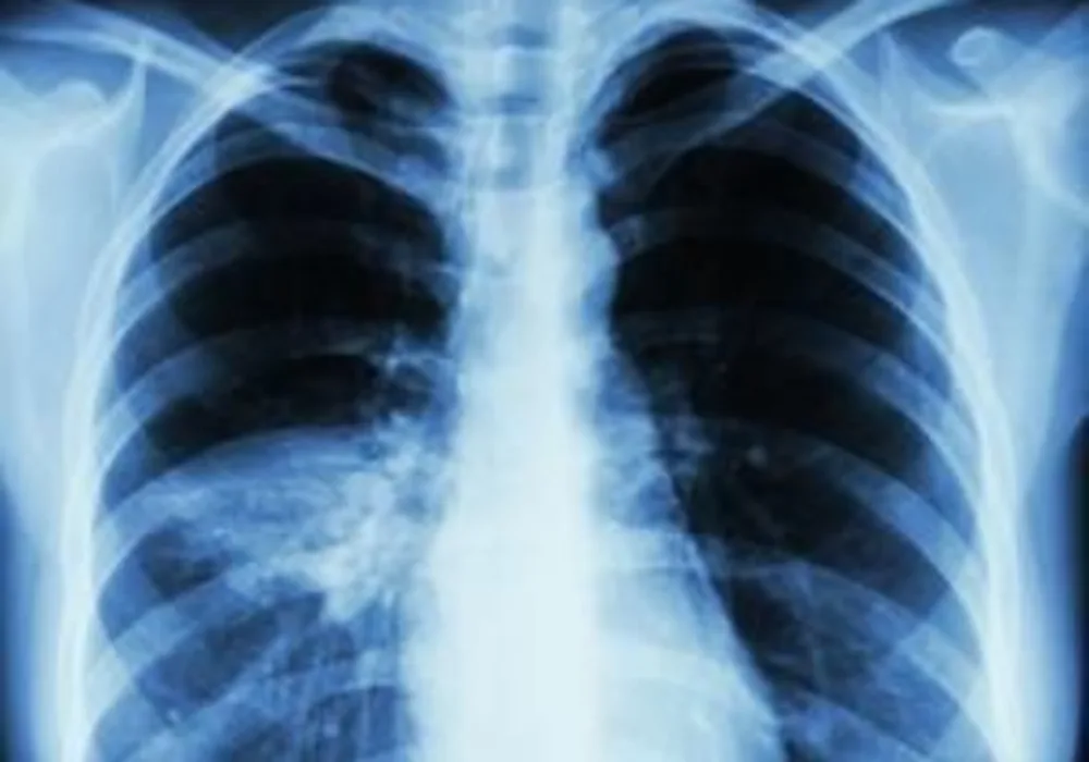 X-ray showing ventilator-associated pneumonia (credit: American Thoracic Society)