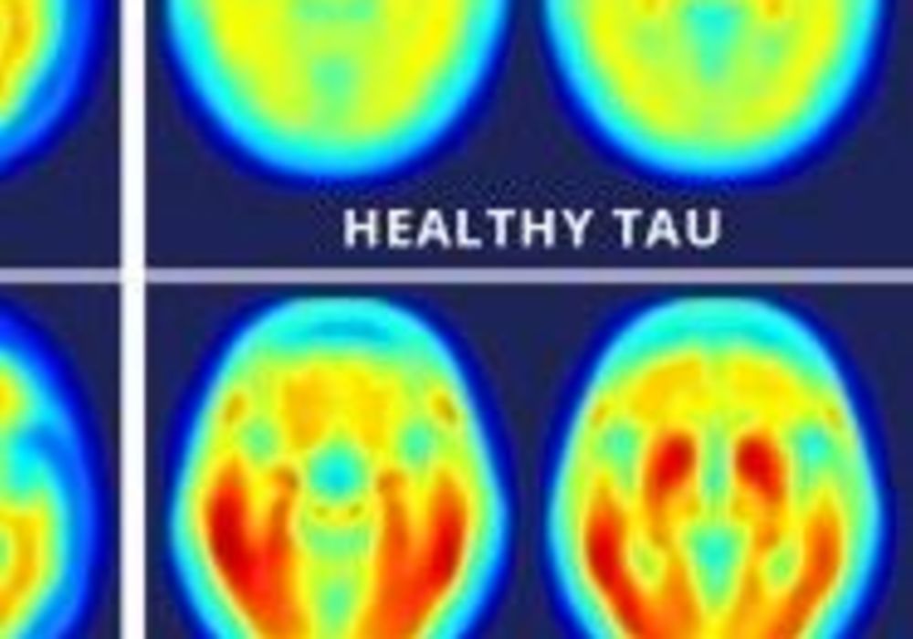 A study using a new PET imaging agent shows that measures of tau protein in the brain more closely track cognitive decline due to Alzheimer&#039;s disease compared with long-studied measures of amyloid beta. More red color indicates more tau protein