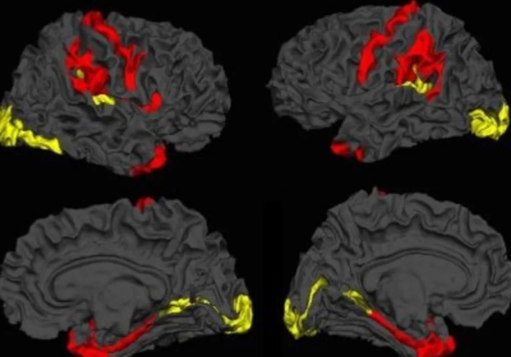 Dynamic cerebral reorganisation in the pathophysiology of schizophrenia: a, MRI-derived cortical thickness study. Credit: Lena Palaniyappan