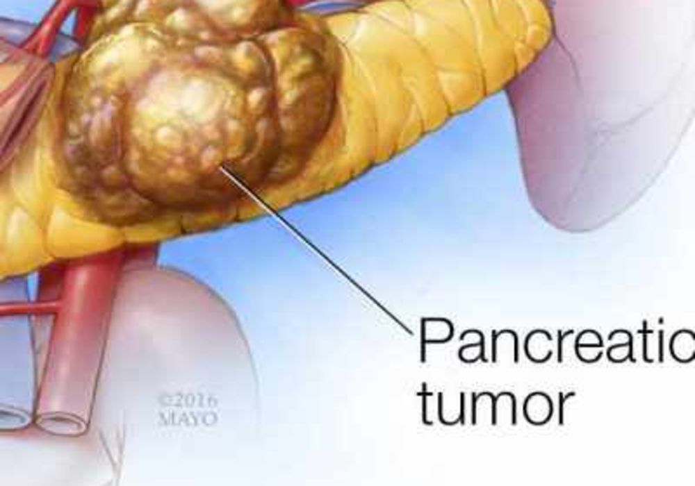 Chemo, Radiation, Surgery Combo Boosts Survival For Pancreatic Cancer