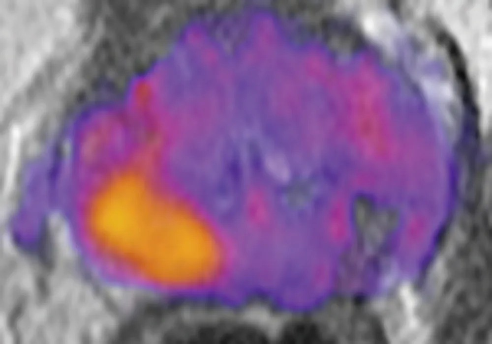 A magnetic resonance image (MRI) of a prostate enhanced with restriction spectrum imaging (RSI). Higher grade tumour is indicated by orange and yellow