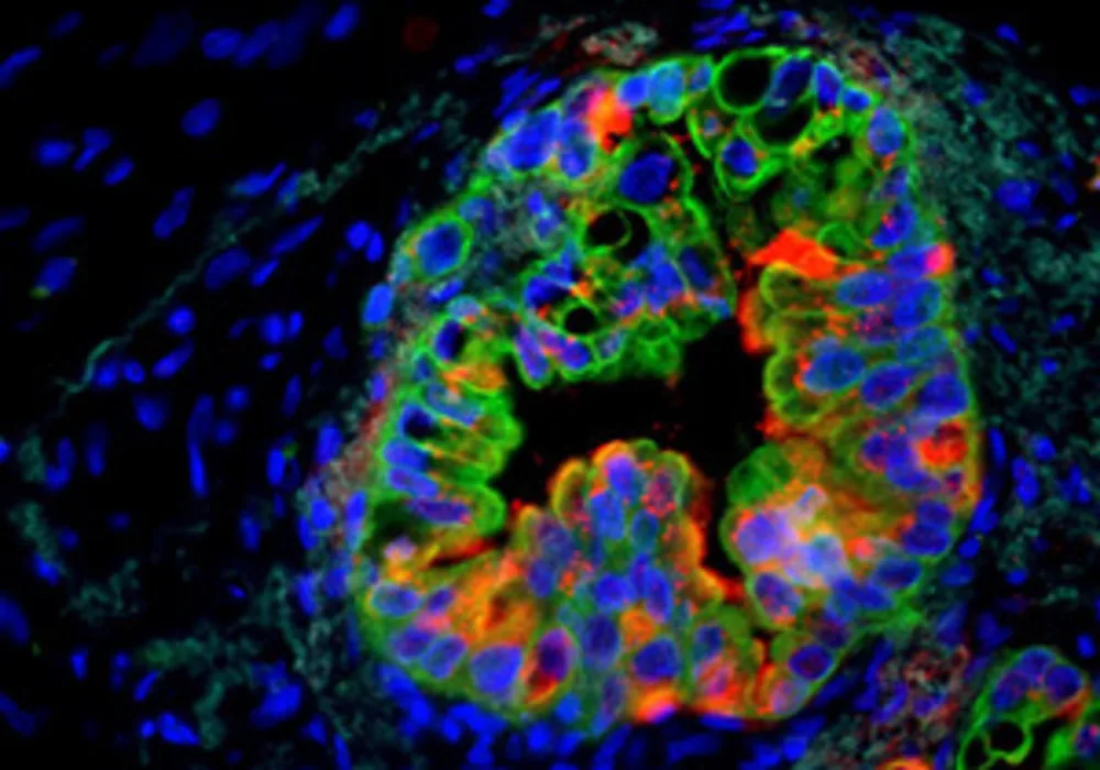 Expression of the stem cell gene Musashi in human pancreatic cancer. Cancer cells are shown in green, Musashi expression in red and blue includes cells within the cancer microenvironment. Image courtesy of Dawn Jaquish, UC San Diego.