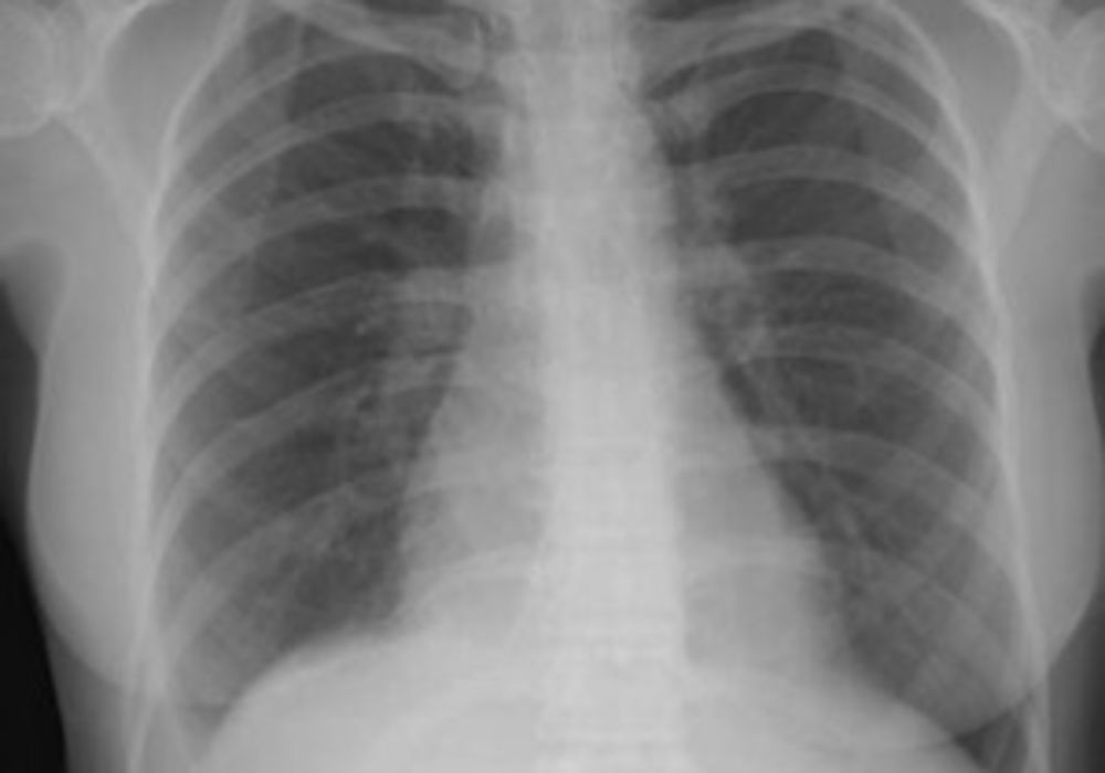 X-ray of injured lung