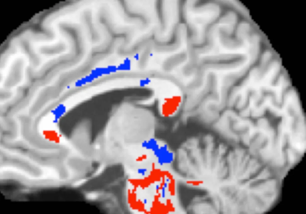 This image of a concussion patient&rsquo;s brain shows low FA areas (red) probably signifying injured white matter, plus high FA areas (blue) perhaps indicating more efficient white-matter connections compensating for concussion damage. A large amount of high F