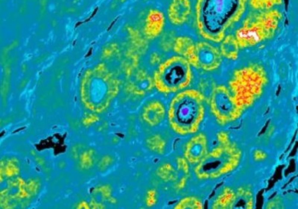 This image shows DCIS sample highlighting aggressive biomarkers. Credit: University of Michigan Health System