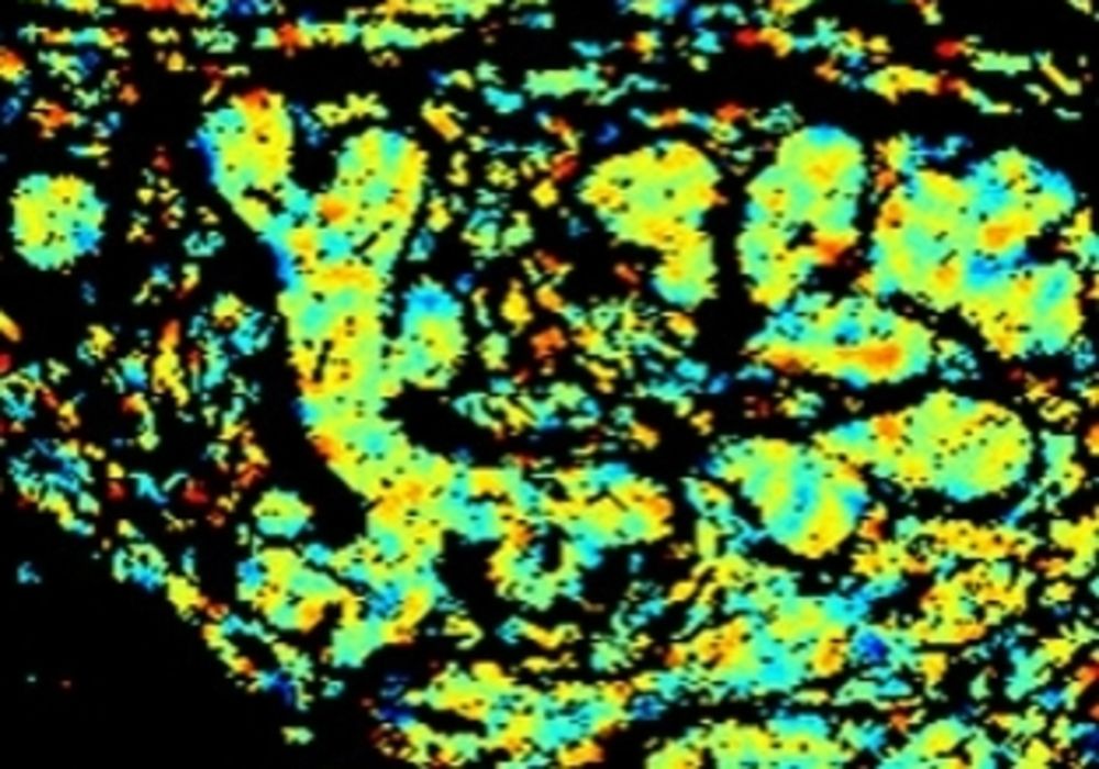 The left image is a tissue sample with low levels of HER2 and HER3 bonded together. The right is a sample with high levels