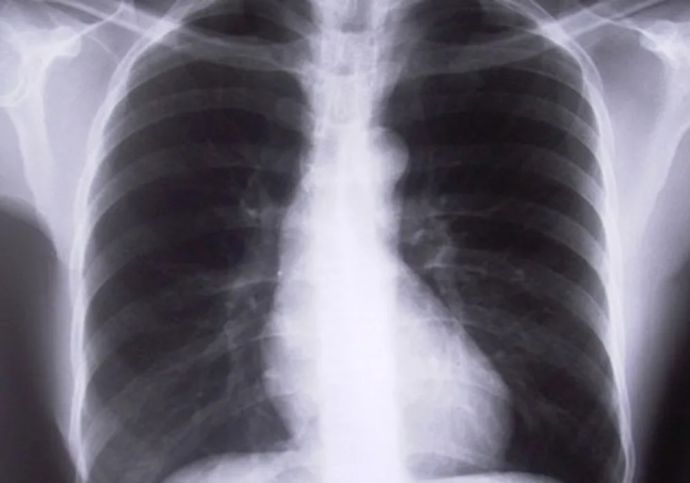 NSNs in Lung Cancer Can Be Managed With Annual CT Scan