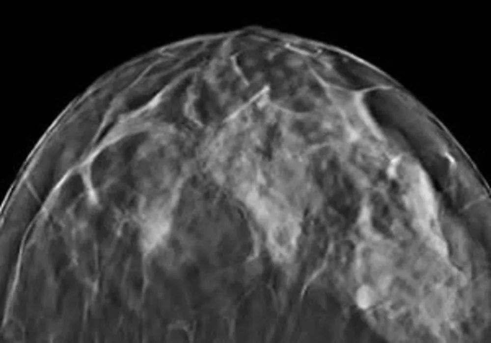 Tomosynthesis - Mammography of the Future? 