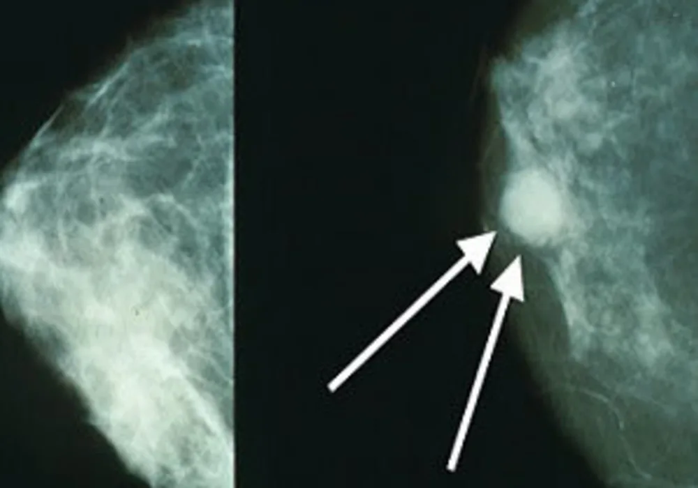 Radiologists Can Detect Breast Cancer in &#039;Blink of an Eye&#039;