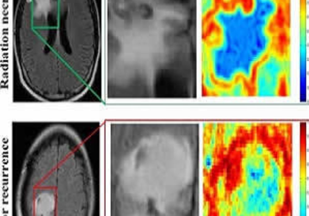 MRI scans of patients with radiation necrosis (above) and cancer recurrence (below) are shown in the left column. Close-ups in the center column show the regions are indistinguishable on routine scans. Radiomic descriptors unearth subtle differences showi