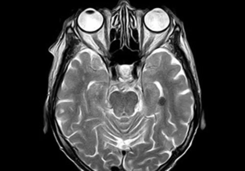 Neuroimaging Findings: Towards More Reliable Analysis 