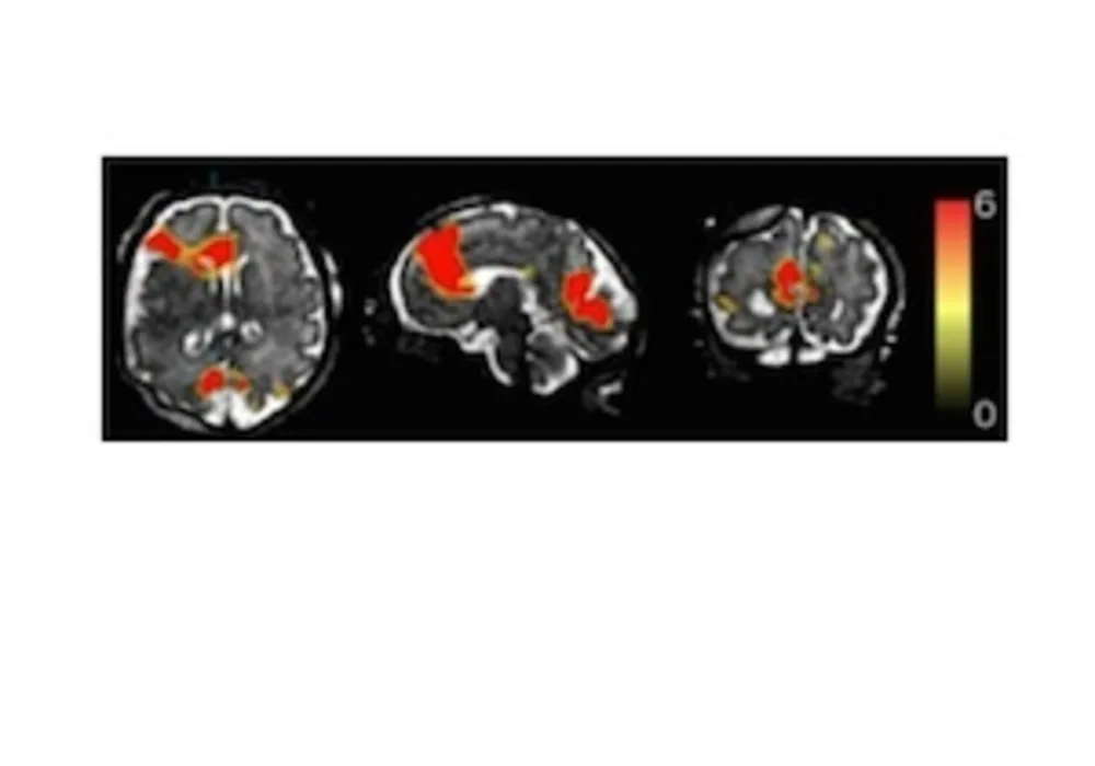 Mapping the Fetal Brain: New Technique 