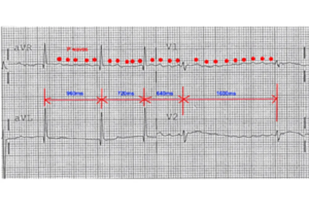 Social Inequality, Lifestyle and Heart Disease