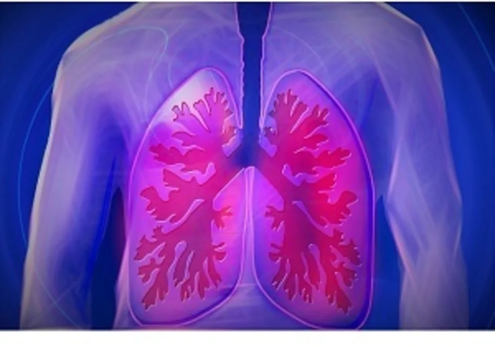 New Model Predicts Lung Cancer Risk in Light and Never Smokers 