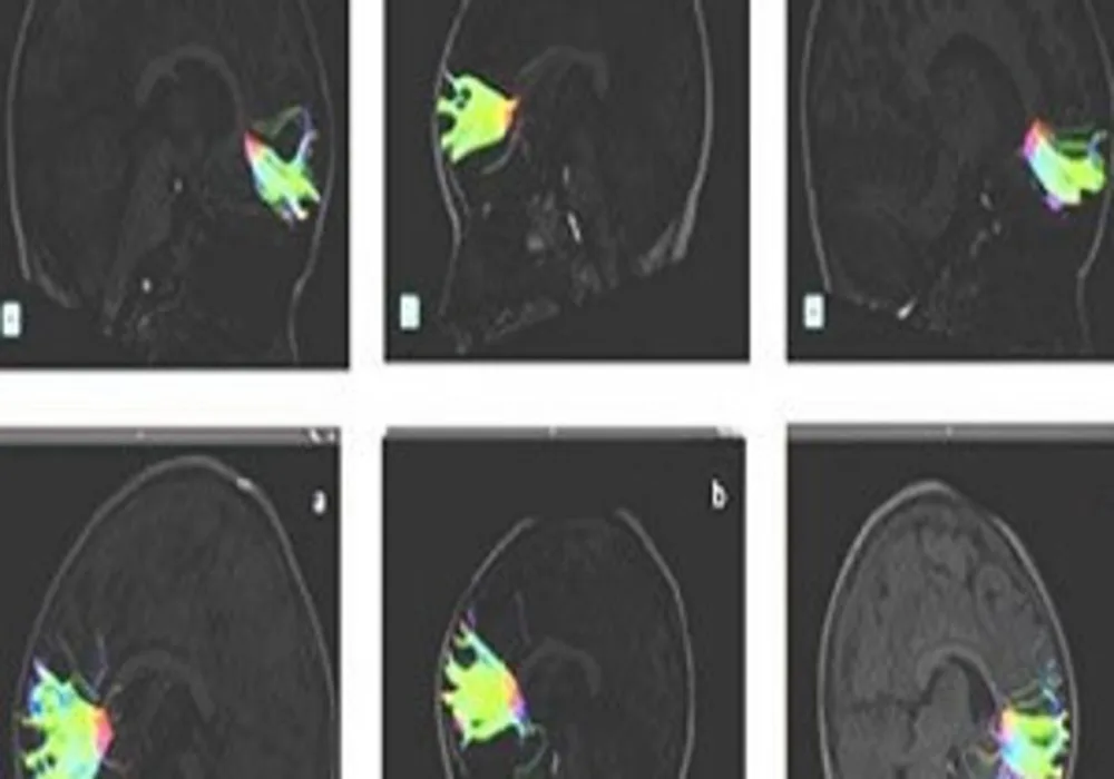 Fibers belonging to the greater forceps pre-musical training are observed (A, B, C). Fibers belonging to the same patients after 9 months of musical training are observed below (a, b, c).