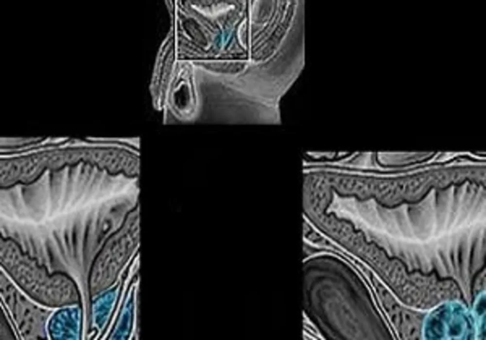 MRI Improves Prostate Cancer Detection, Avoids Unneeded Biopsy