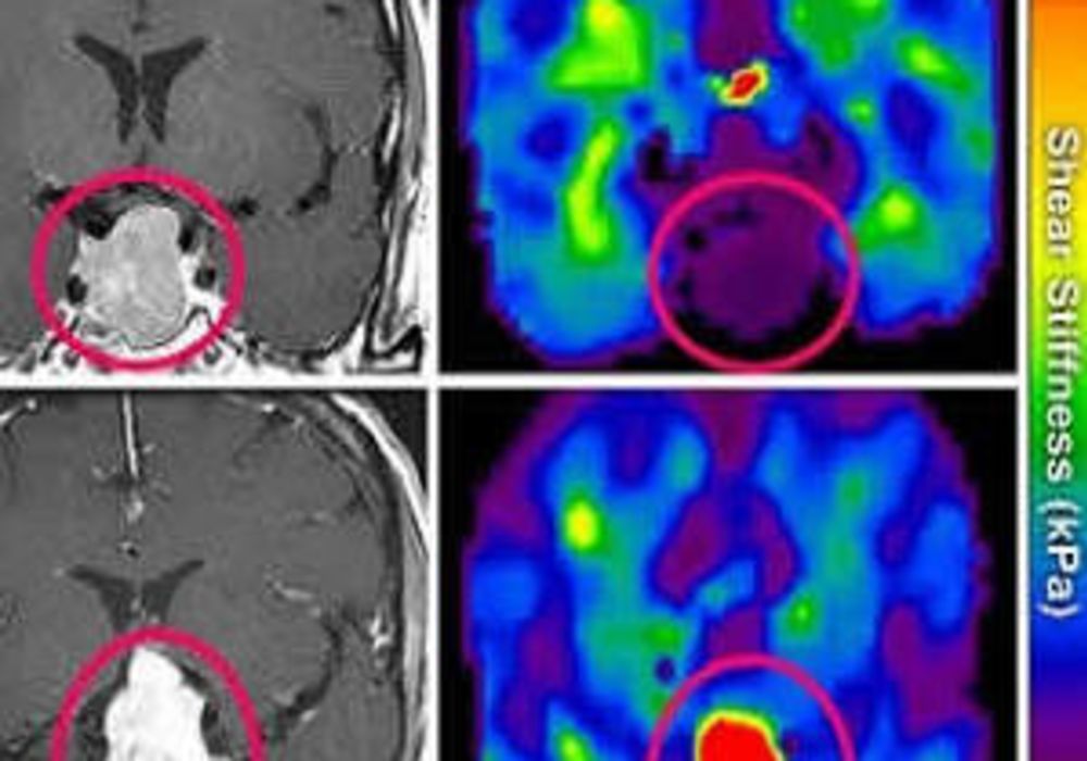 Magnetic Resonance Elastography as Tool for Surgical Planning