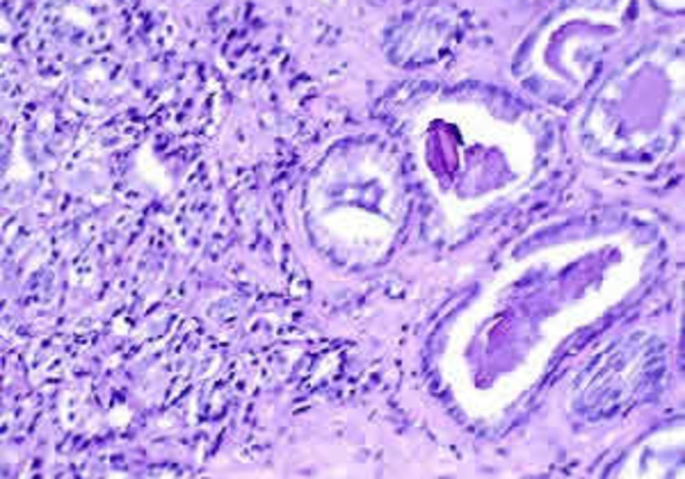 Normal and Malignant Prostates on MRI: Shape Differences 